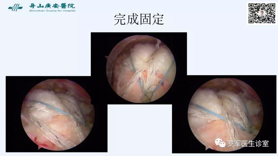 治疗肩袖撕裂，告诉你一种新的修补技术！