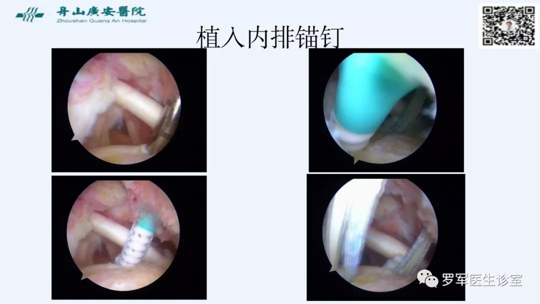 治疗肩袖撕裂，告诉你一种新的修补技术！