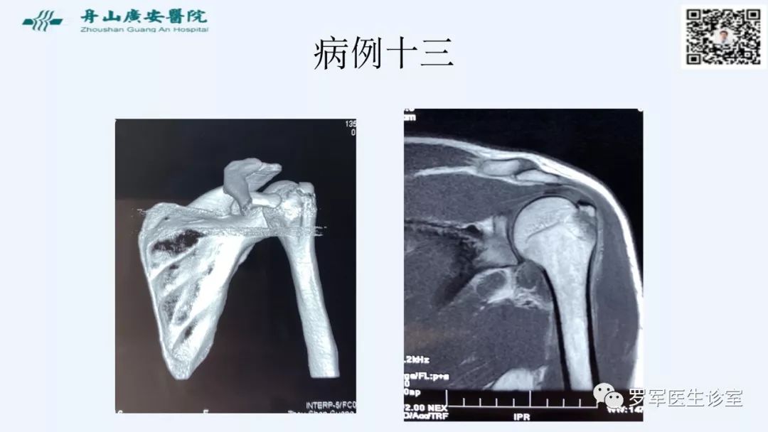 治疗肩袖撕裂，告诉你一种新的修补技术！