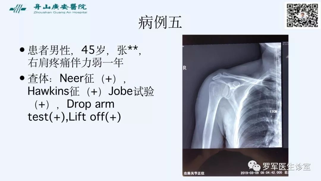 治疗肩袖撕裂，告诉你一种新的修补技术！