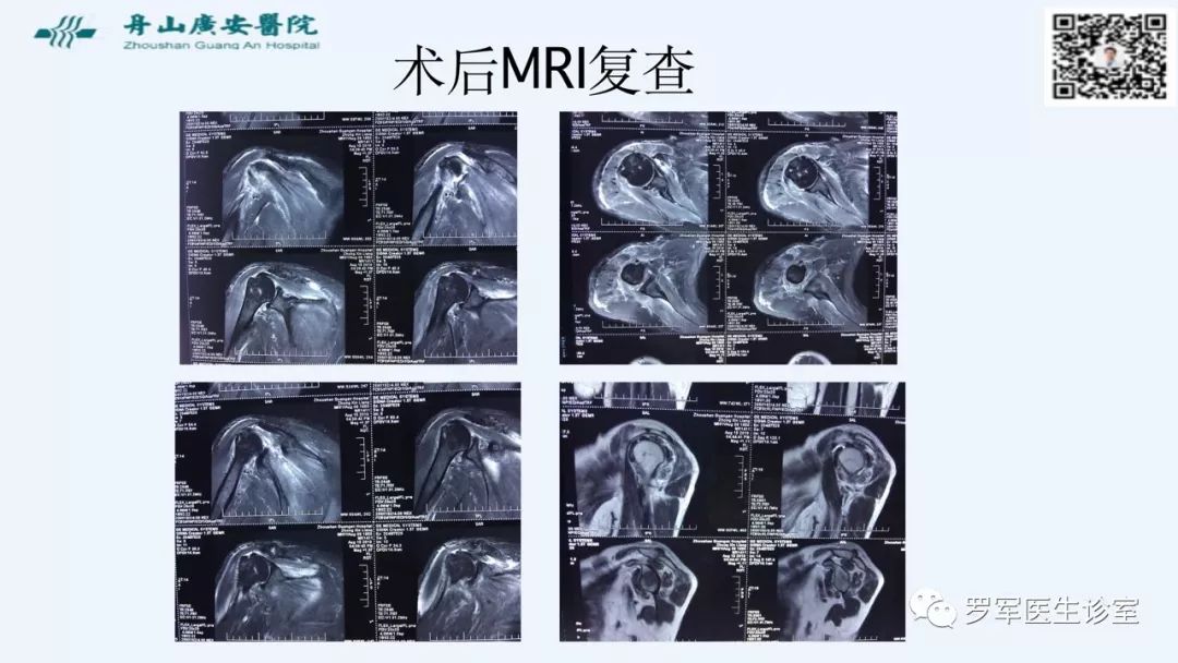 治疗肩袖撕裂，告诉你一种新的修补技术！