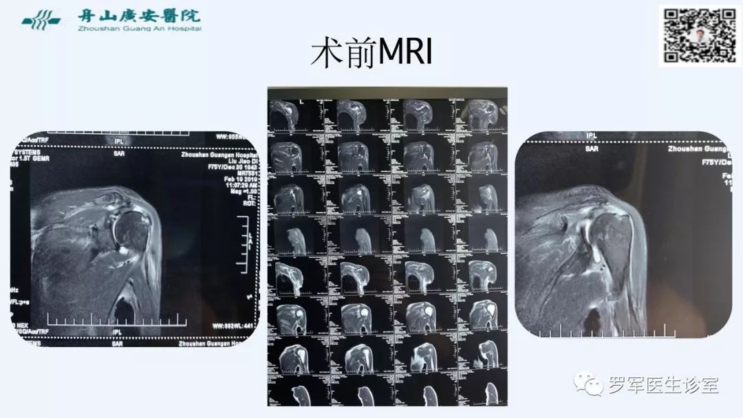 治疗肩袖撕裂，告诉你一种新的修补技术！