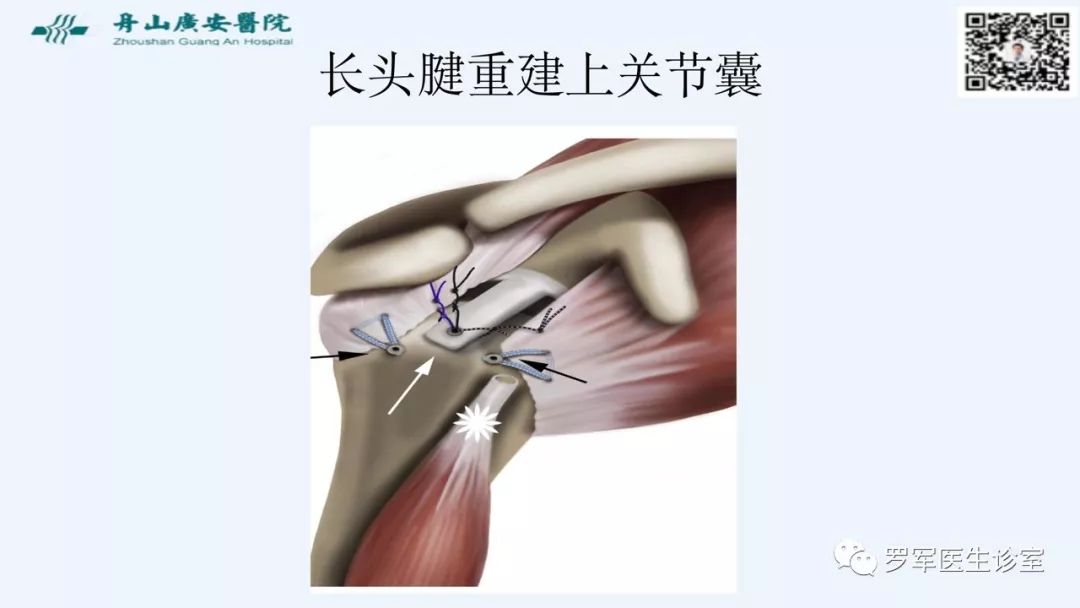 治疗肩袖撕裂，告诉你一种新的修补技术！