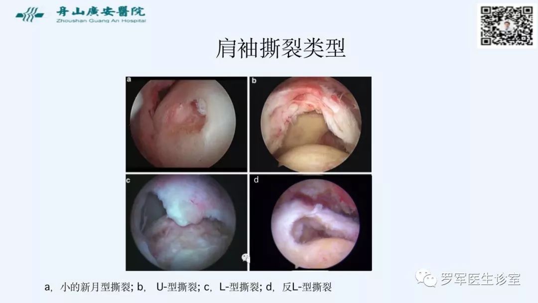 治疗肩袖撕裂，告诉你一种新的修补技术！