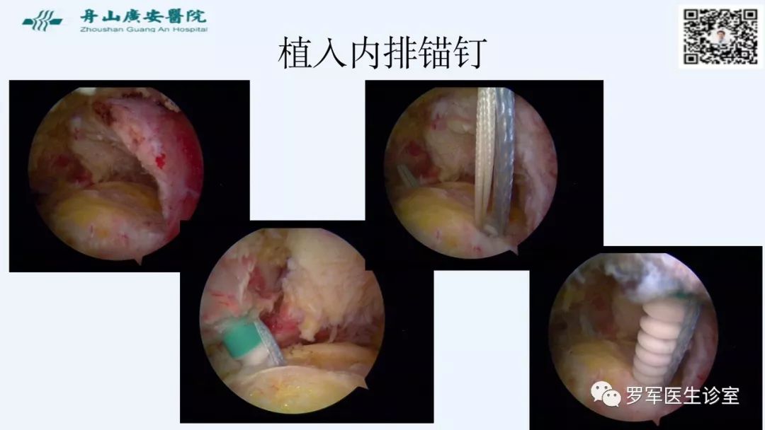 治疗肩袖撕裂，告诉你一种新的修补技术！