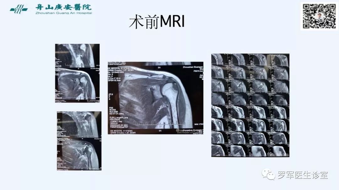 治疗肩袖撕裂，告诉你一种新的修补技术！