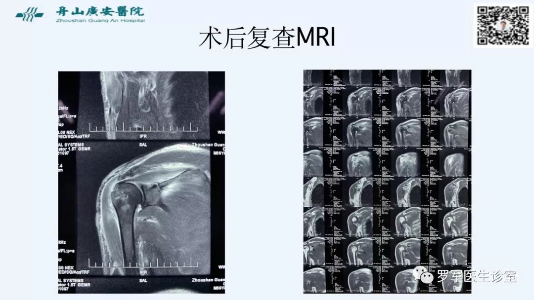 治疗肩袖撕裂，告诉你一种新的修补技术！