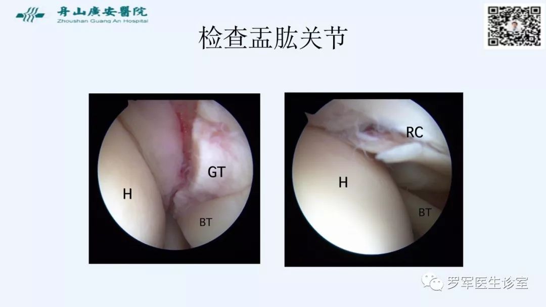 治疗肩袖撕裂，告诉你一种新的修补技术！