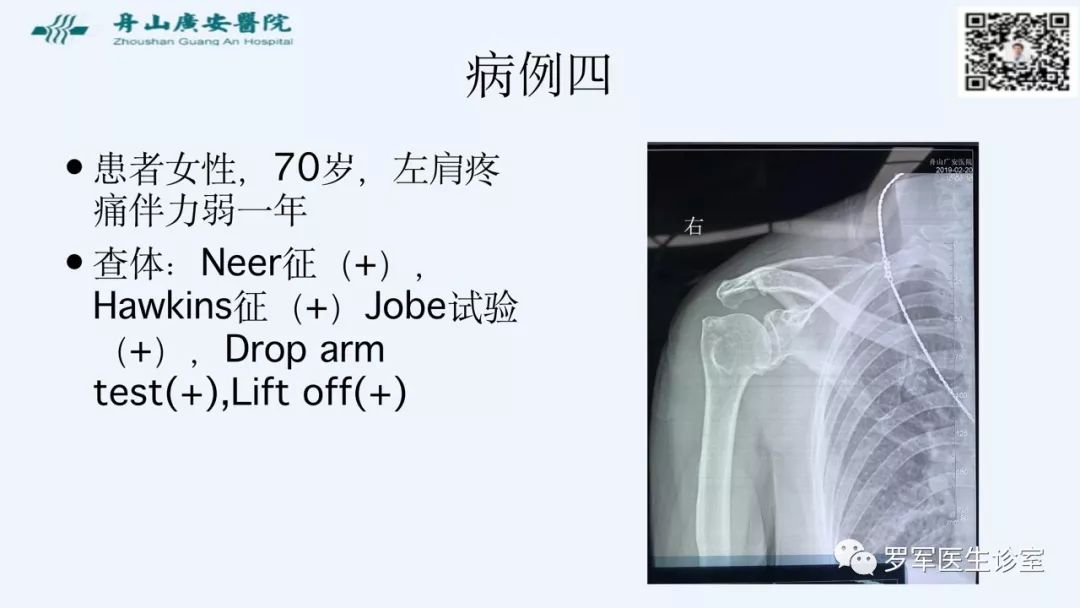 治疗肩袖撕裂，告诉你一种新的修补技术！