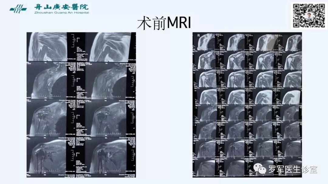 治疗肩袖撕裂，告诉你一种新的修补技术！