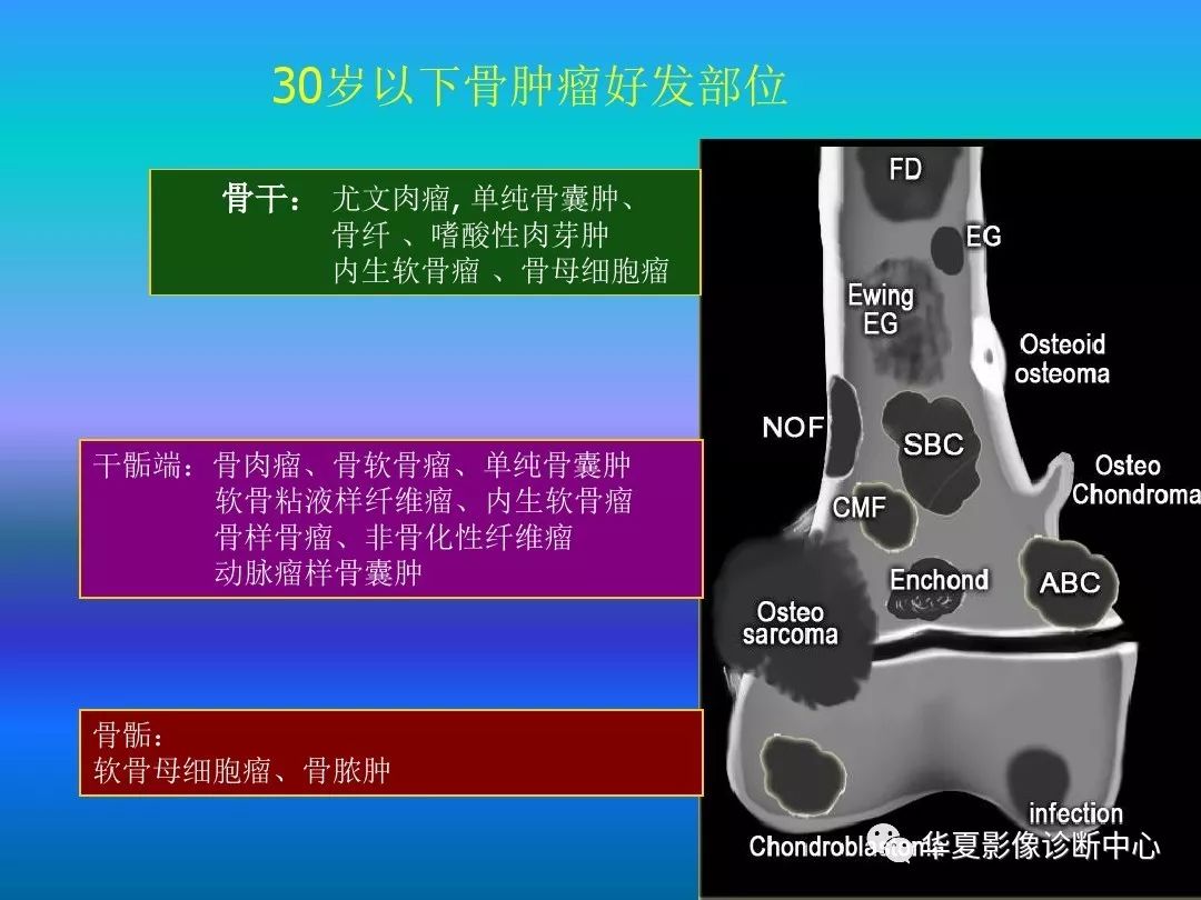 骨肿瘤/肿瘤样病变的影像诊断及策略，看这篇就够了！