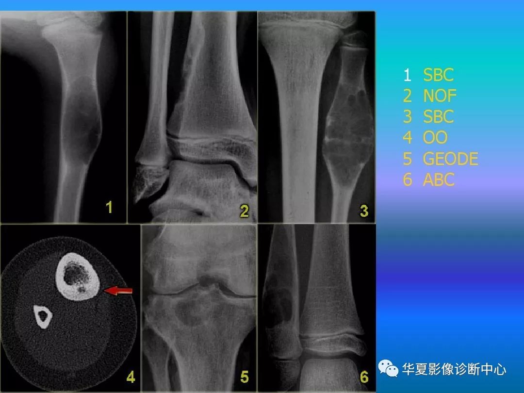 骨肿瘤/肿瘤样病变的影像诊断及策略，看这篇就够了！