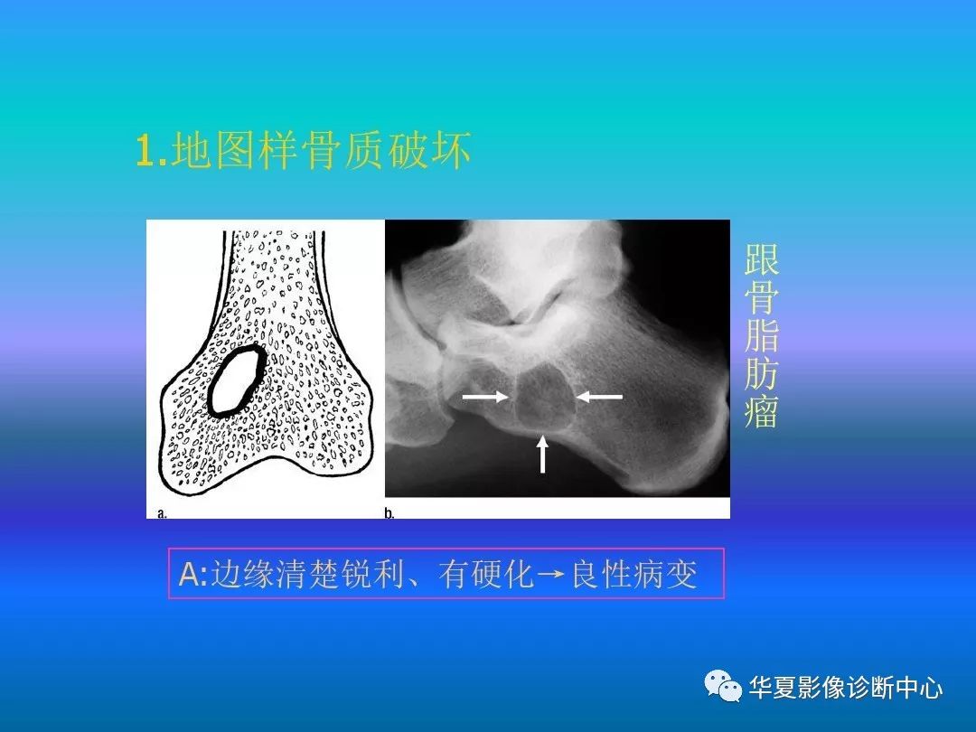 骨肿瘤/肿瘤样病变的影像诊断及策略，看这篇就够了！