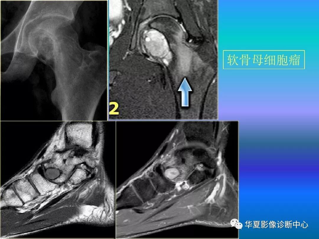 骨肿瘤/肿瘤样病变的影像诊断及策略，看这篇就够了！