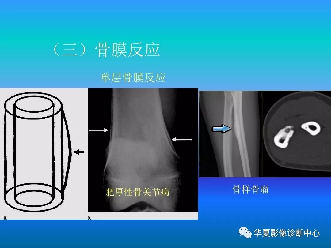 骨肿瘤/肿瘤样病变的影像诊断及策略，看这篇就够了！