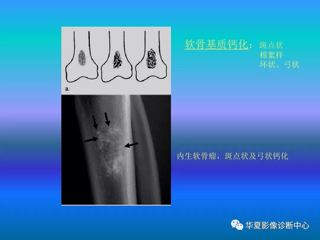 骨肿瘤/肿瘤样病变的影像诊断及策略，看这篇就够了！