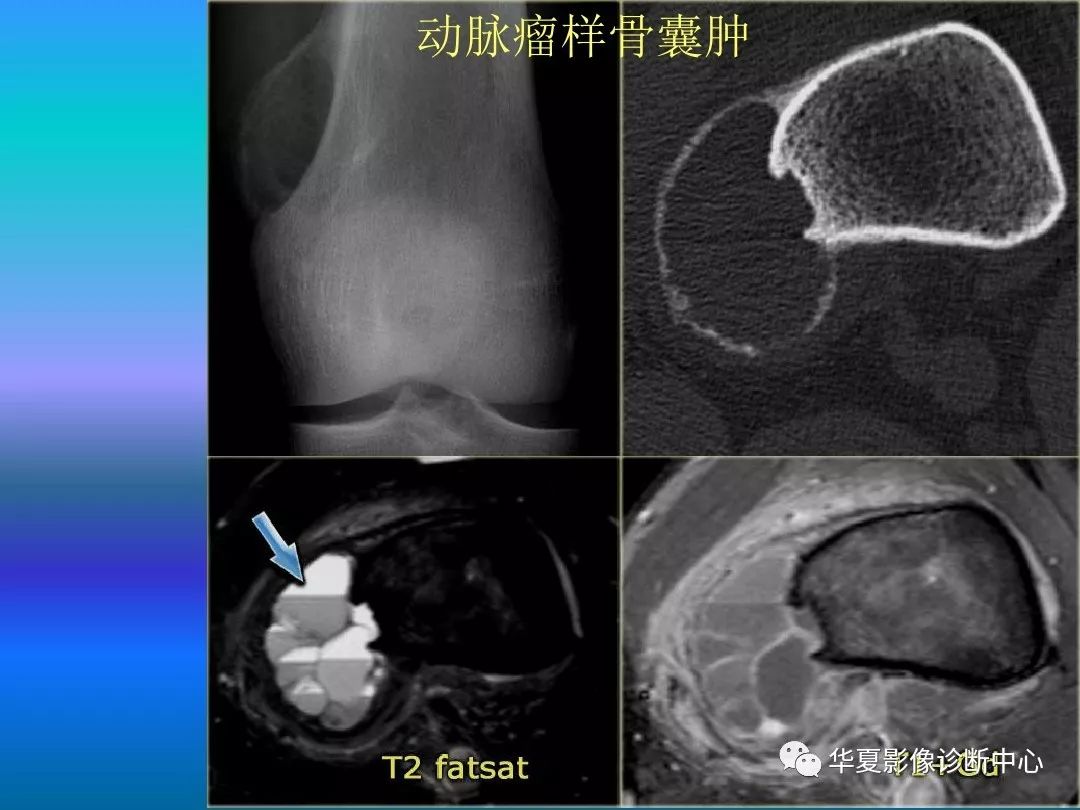 骨肿瘤/肿瘤样病变的影像诊断及策略，看这篇就够了！