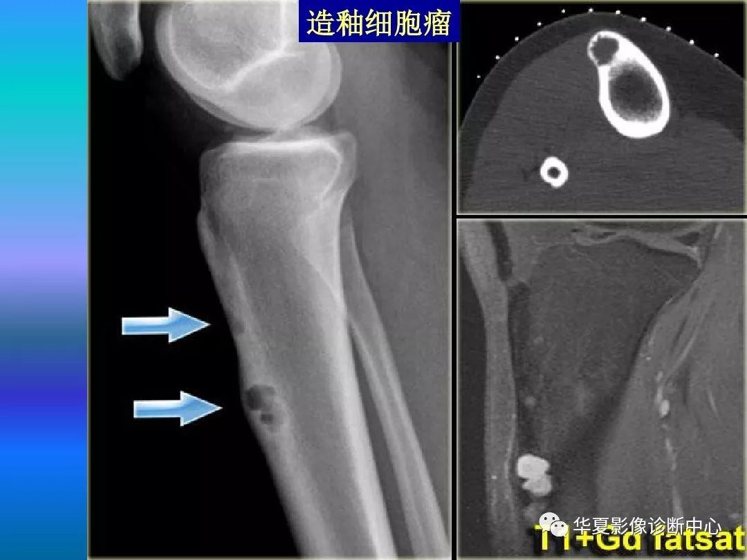 骨肿瘤/肿瘤样病变的影像诊断及策略，看这篇就够了！