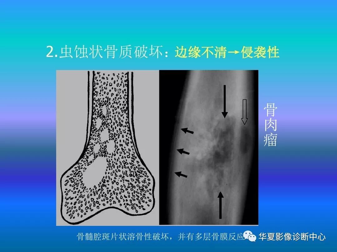 骨肿瘤/肿瘤样病变的影像诊断及策略，看这篇就够了！