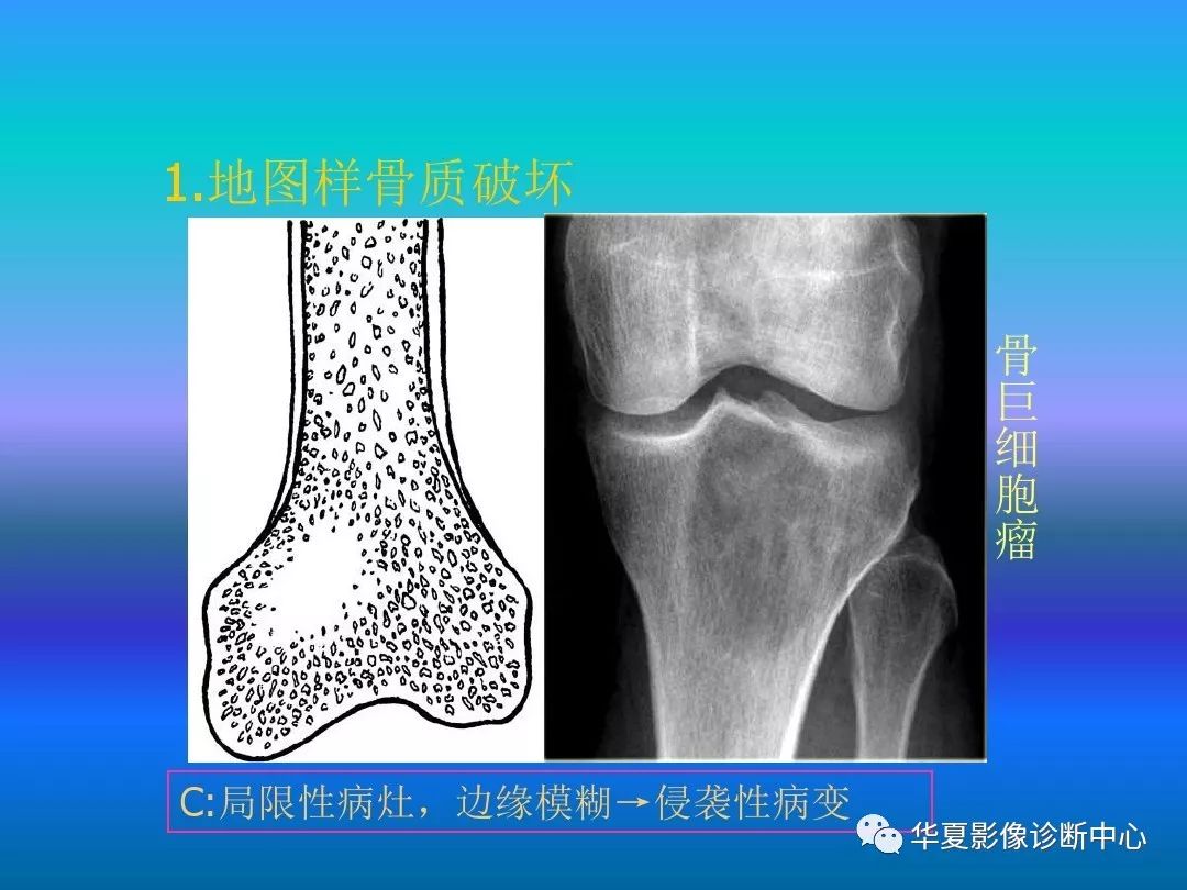 骨肿瘤/肿瘤样病变的影像诊断及策略，看这篇就够了！