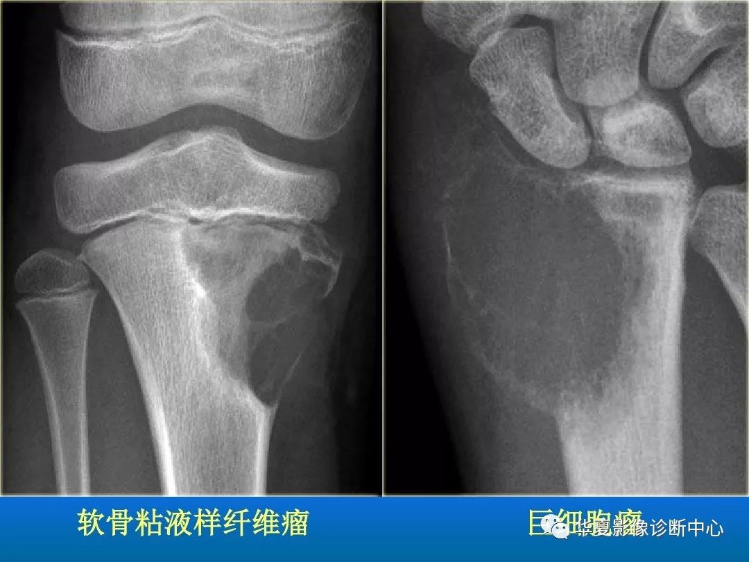 骨肿瘤/肿瘤样病变的影像诊断及策略，看这篇就够了！