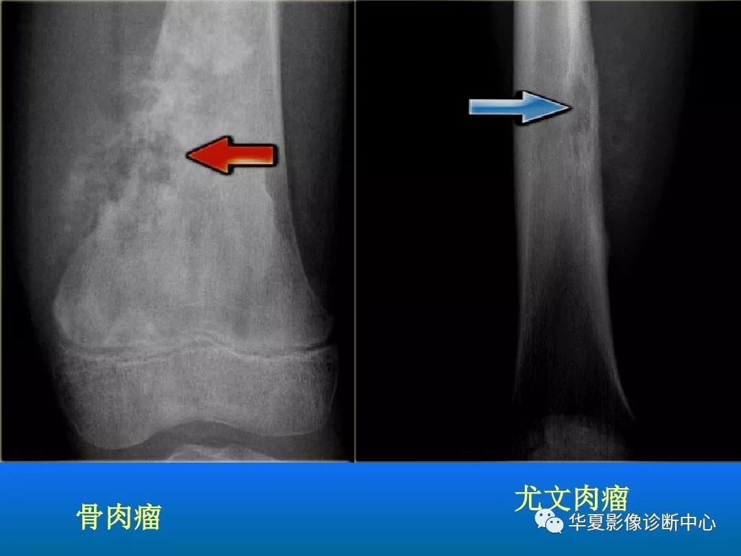 骨肿瘤/肿瘤样病变的影像诊断及策略，看这篇就够了！