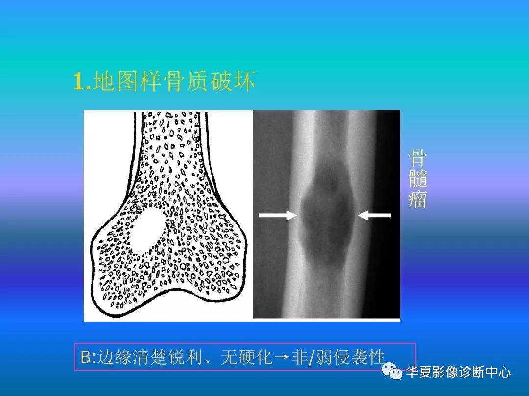 骨肿瘤/肿瘤样病变的影像诊断及策略，看这篇就够了！