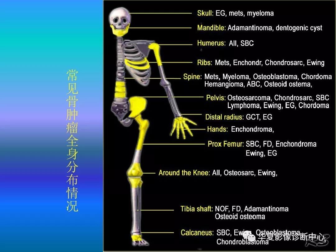 骨肿瘤/肿瘤样病变的影像诊断及策略，看这篇就够了！