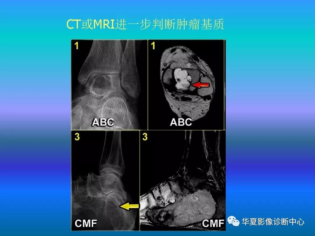 骨肿瘤/肿瘤样病变的影像诊断及策略，看这篇就够了！