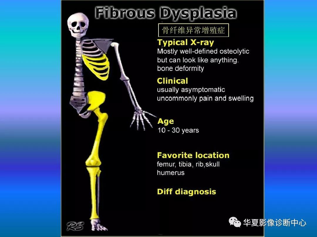 骨肿瘤/肿瘤样病变的影像诊断及策略，看这篇就够了！