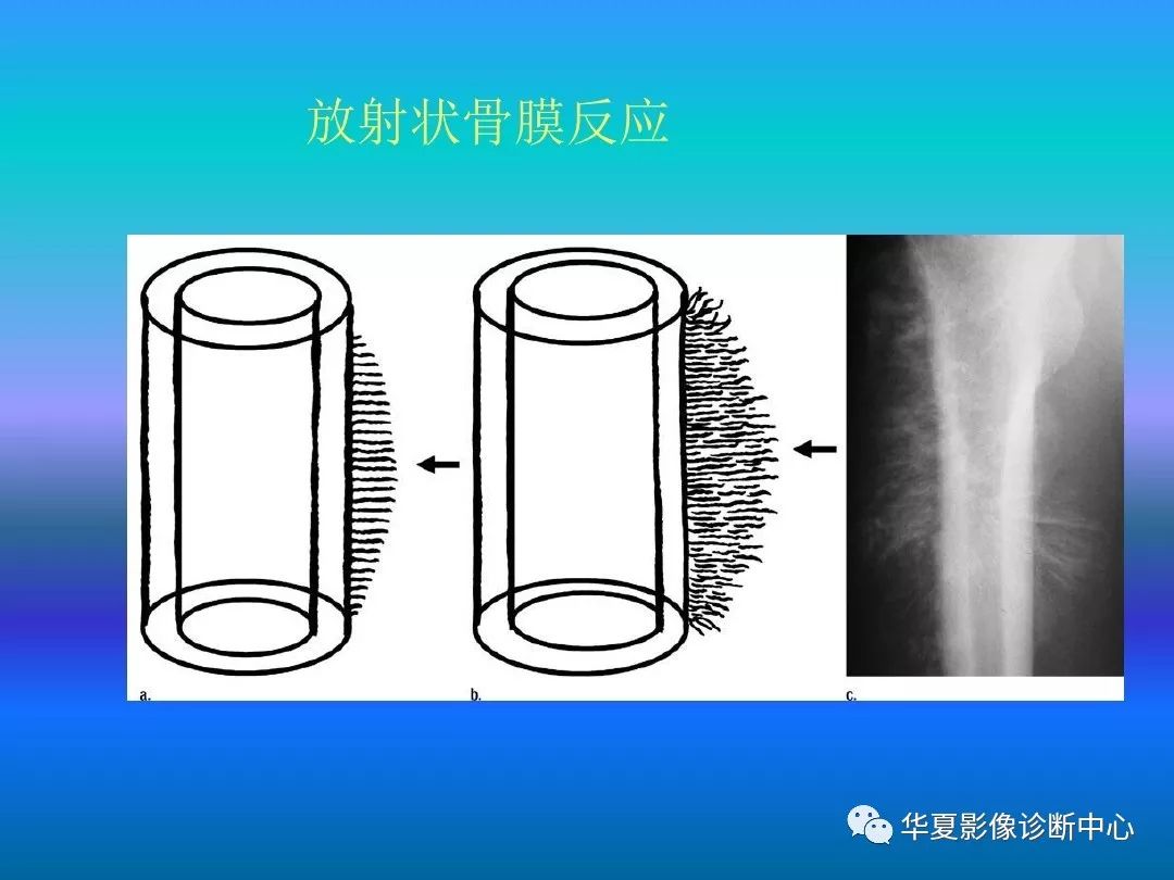 骨肿瘤/肿瘤样病变的影像诊断及策略，看这篇就够了！