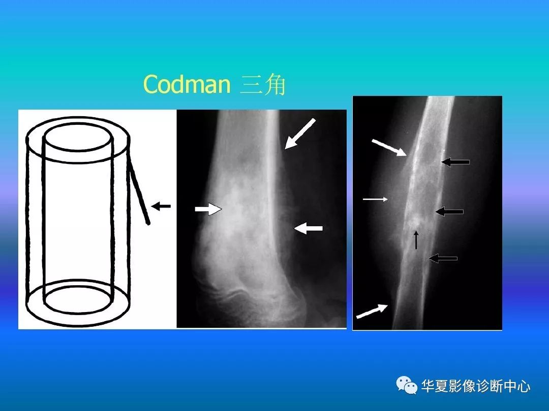 骨肿瘤/肿瘤样病变的影像诊断及策略，看这篇就够了！