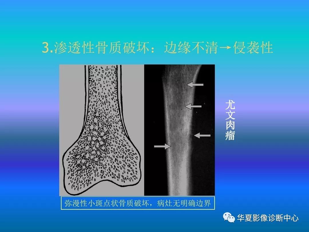 骨肿瘤/肿瘤样病变的影像诊断及策略，看这篇就够了！