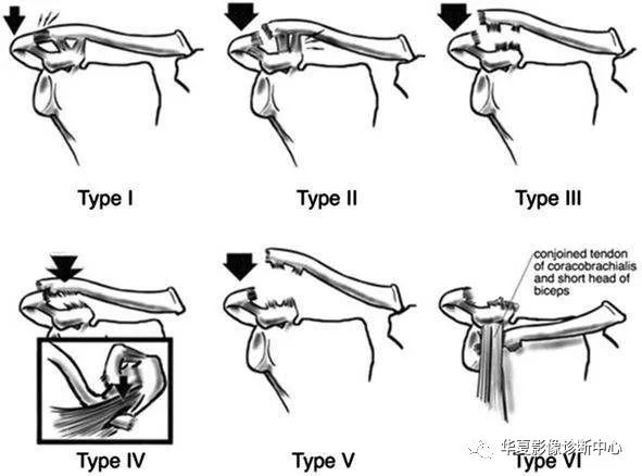 肩锁关节脱位如何分型？