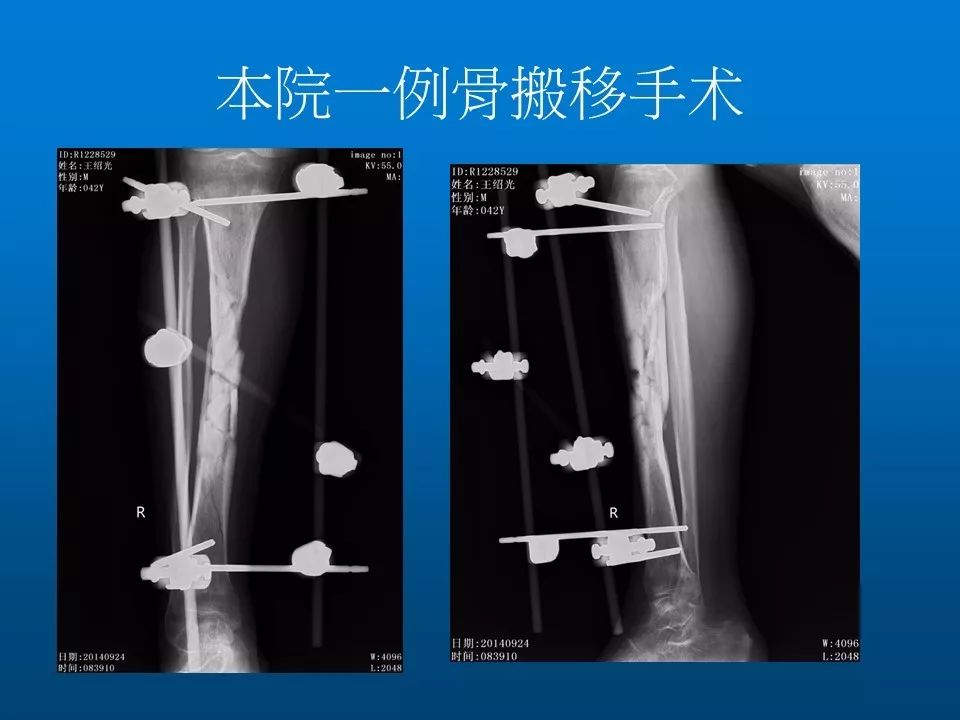 实用！慢性骨髓炎的诊断和治疗