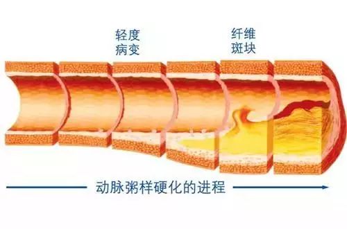 颈动脉斑块与动脉粥样硬化