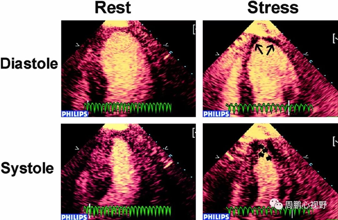 冠心病的无创性评估手段这么多，你都掌握了吗？