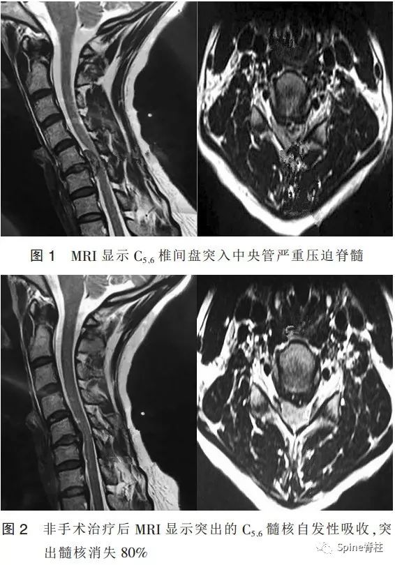 系统详解：突出椎间盘的自发重吸收