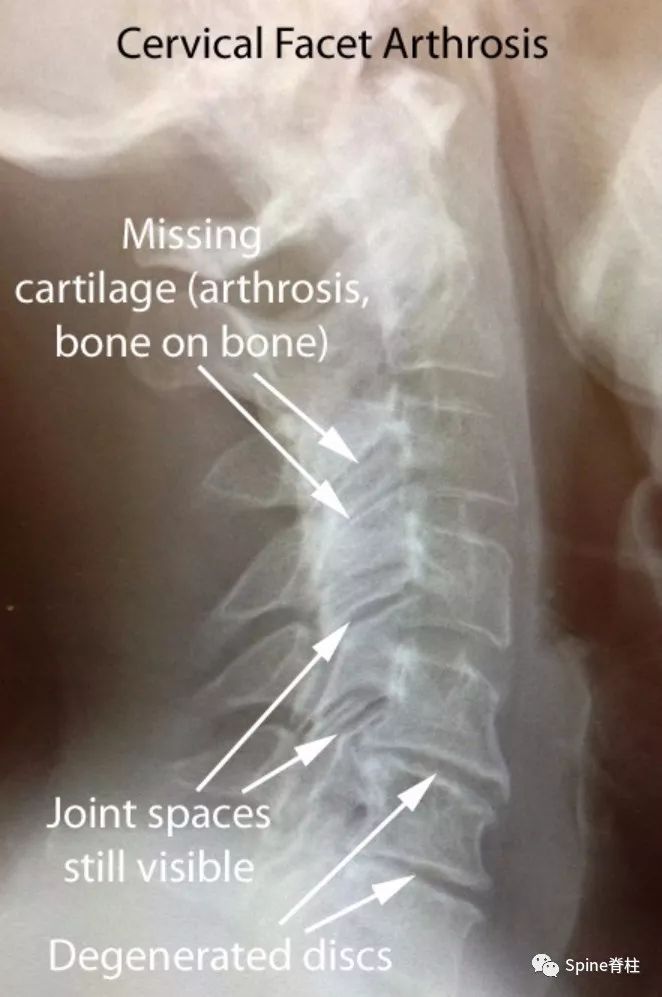 颈椎X线片能给我们诊断带来那些提示呢？