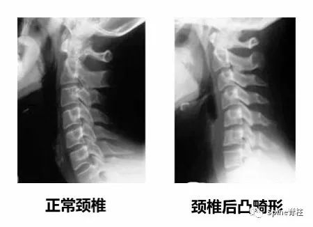 颈椎X线片能给我们诊断带来那些提示呢？