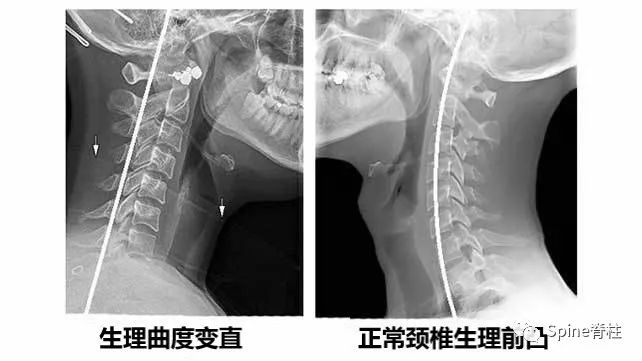 颈椎X线片能给我们诊断带来那些提示呢？