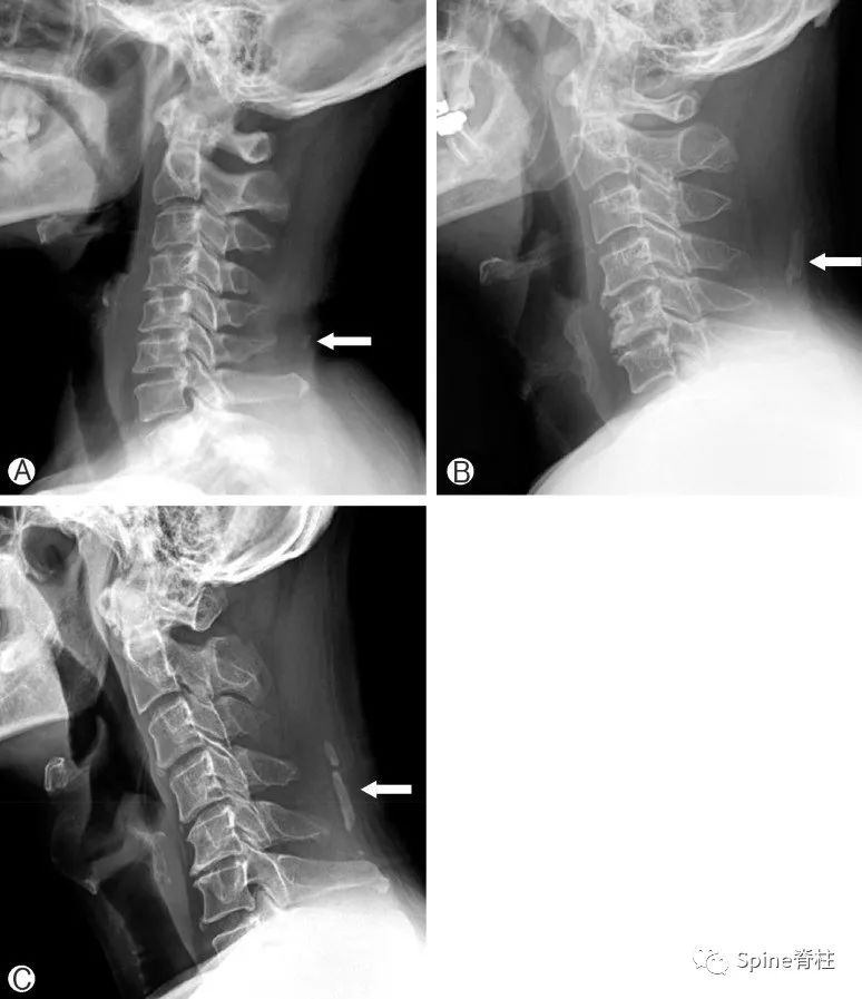 颈椎X线片能给我们诊断带来那些提示呢？