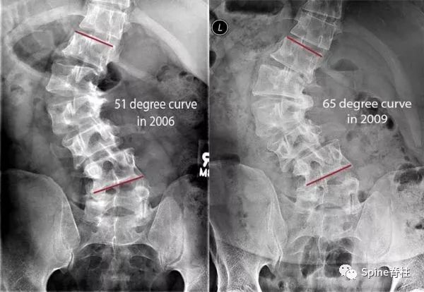 想系统了解成人脊柱畸形？看看这篇！