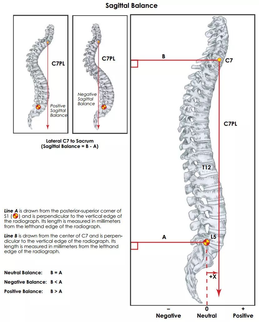 想系统了解成人脊柱畸形？看看这篇！