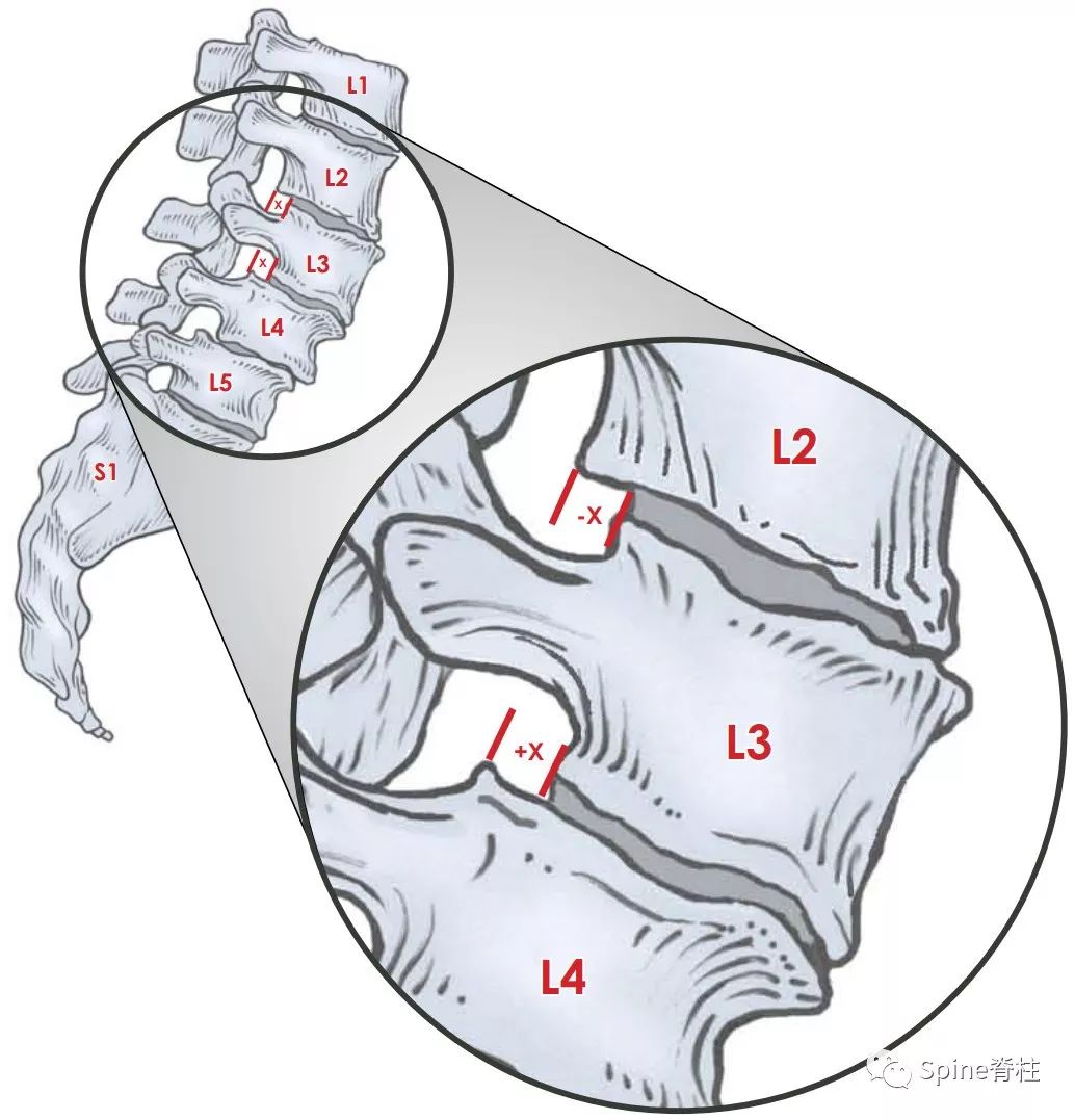 脊椎脊柱侧凸的类型 向量例证. 插画 包括有 骶骨, 胸部, 手术, 疾病, 诊断, 向量, 脊髓, 不正确 - 95633023