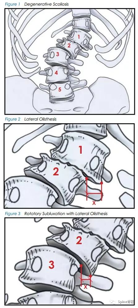 想系统了解成人脊柱畸形？看看这篇！