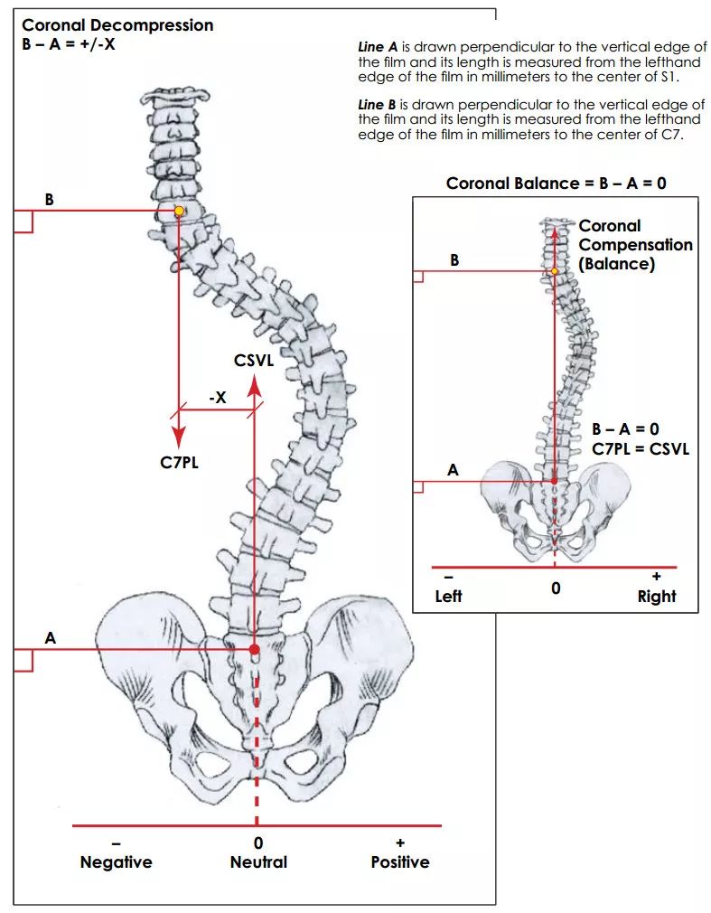 想系统了解成人脊柱畸形？看看这篇！