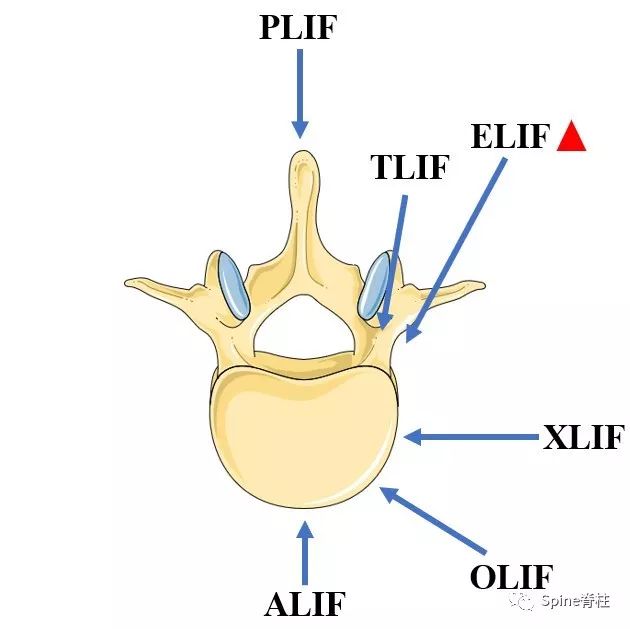 一篇掌握：椎间孔外腰椎椎体间融合术（ELIF）