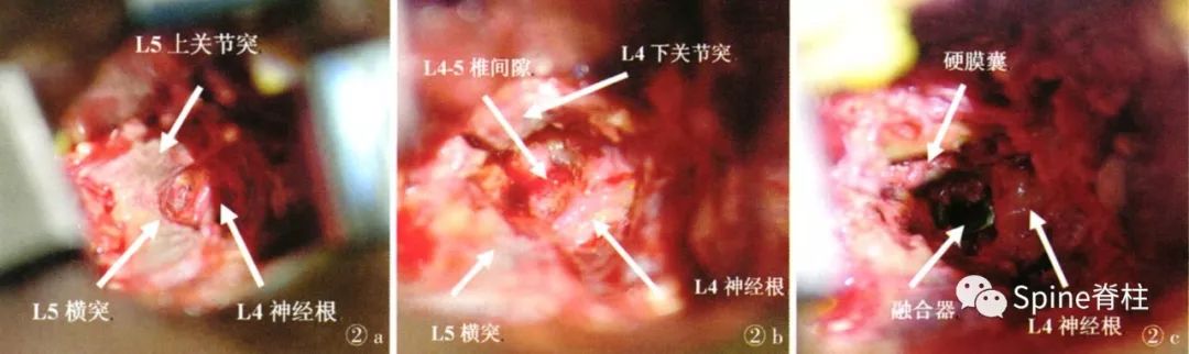 一篇掌握：椎间孔外腰椎椎体间融合术（ELIF）