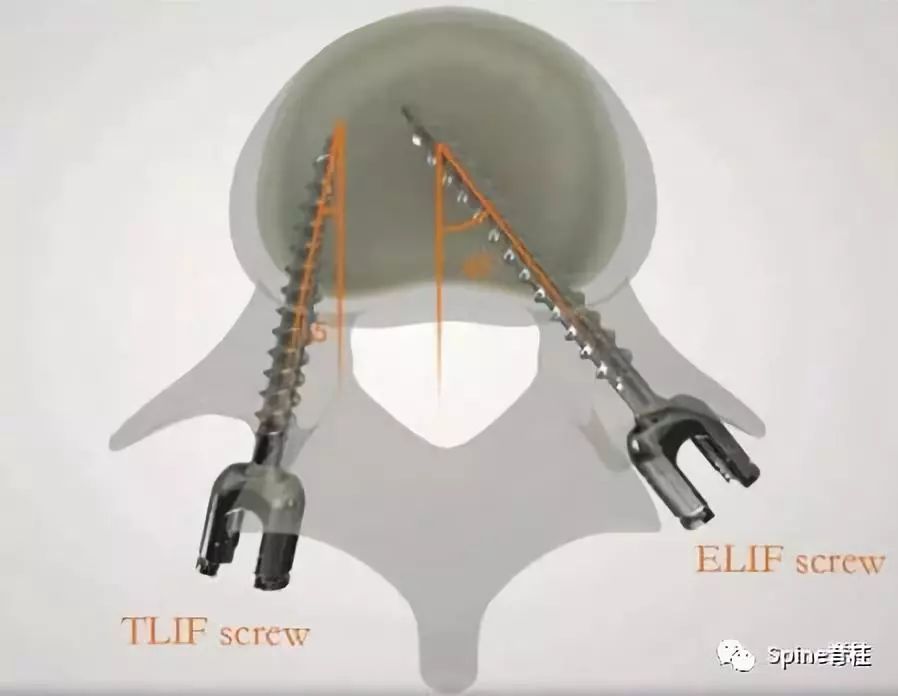 一篇掌握：椎间孔外腰椎椎体间融合术（ELIF）